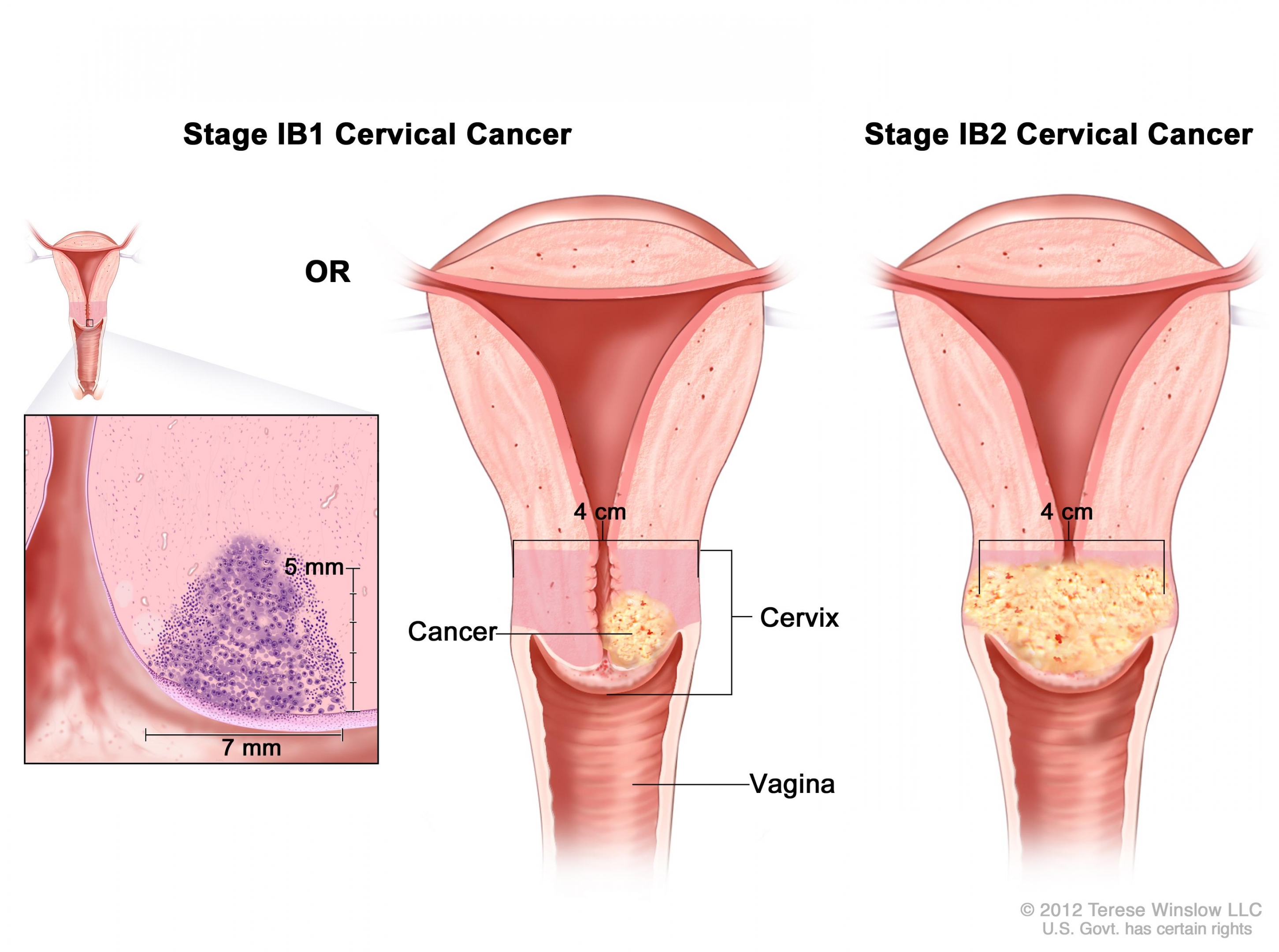 Cervical cancer: symptoms and signs